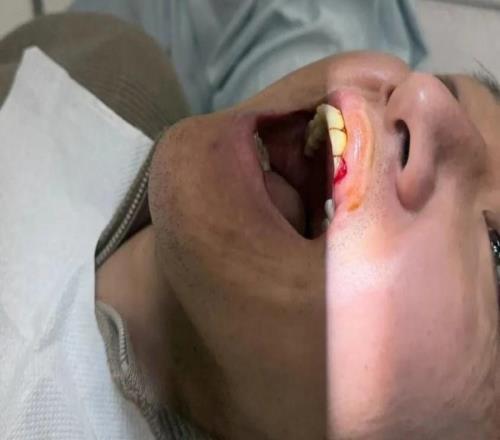 高迪嘴部受傷縫了九針：全力治療恢復，不想錯過與申花的比賽