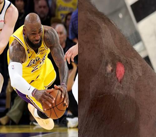 詹姆斯曬傷口喊疼！調侃今年救球到此結束祝賀東契奇當選周最佳