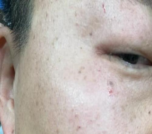 被誤傷，一名國(guó)安球迷昨日觀賽遭球悶中面部，并且眼鏡損壞