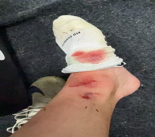 记者晒李帅脚部伤口照：李帅狠人打满全场，这一下甚至没吹犯规
