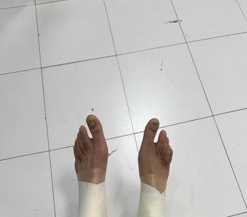 硬汉！32岁老将两腿全拉伤，缠满绷带打20分钟，媒体人真是拼了